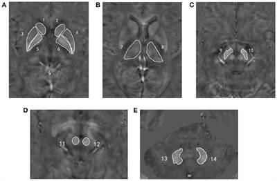 Iron Deposition in Gray Matter Nuclei of Patients With Intracranial Artery Stenosis: A Quantitative Susceptibility Mapping Study